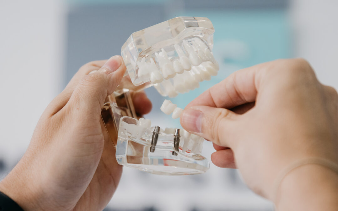 Implantes dentales en un solo día