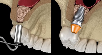 Regeneración ósea dental para implantes dentales: recupera la salud de tu sonrisa en Clínica CS Dental