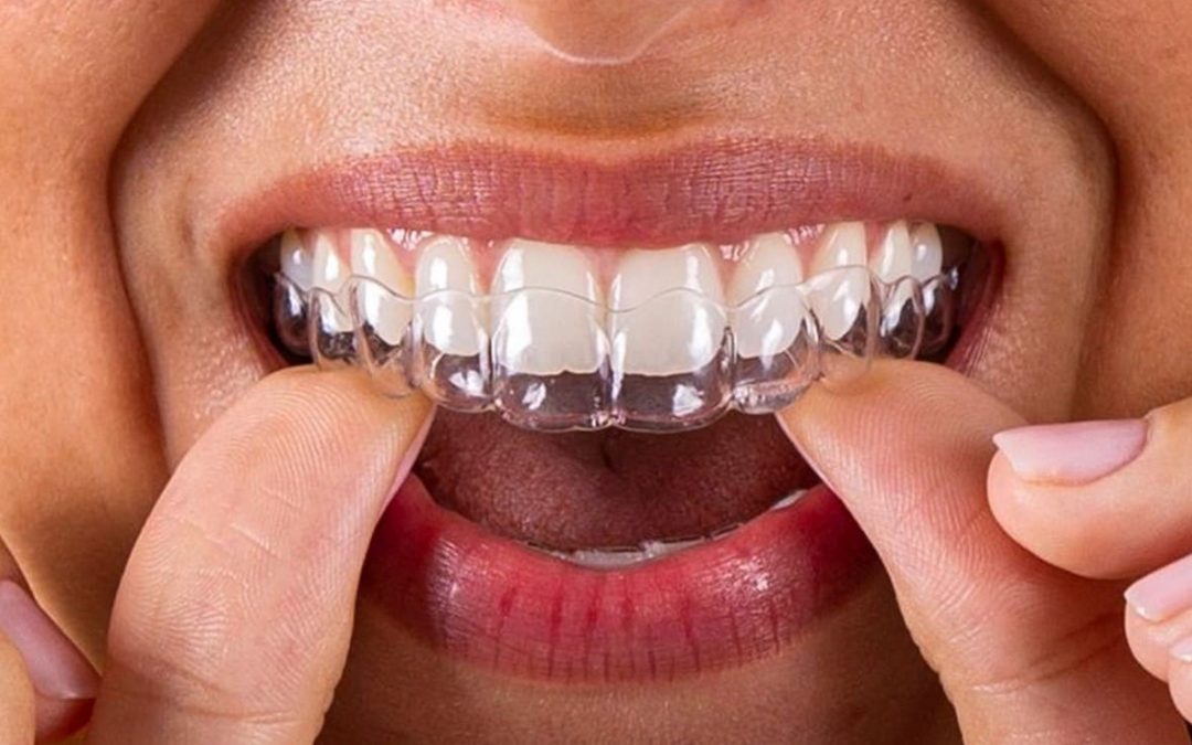 Los beneficios de la ortodoncia invisible para mejorar tu sonrisa