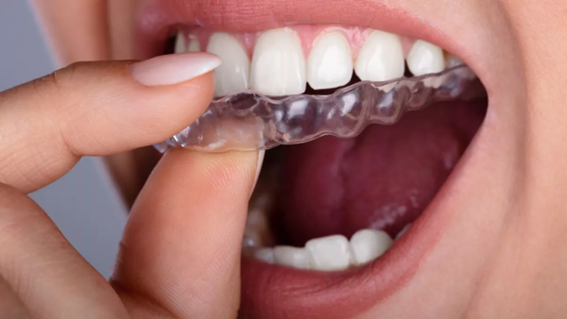 ventajas ortodoncia invisible