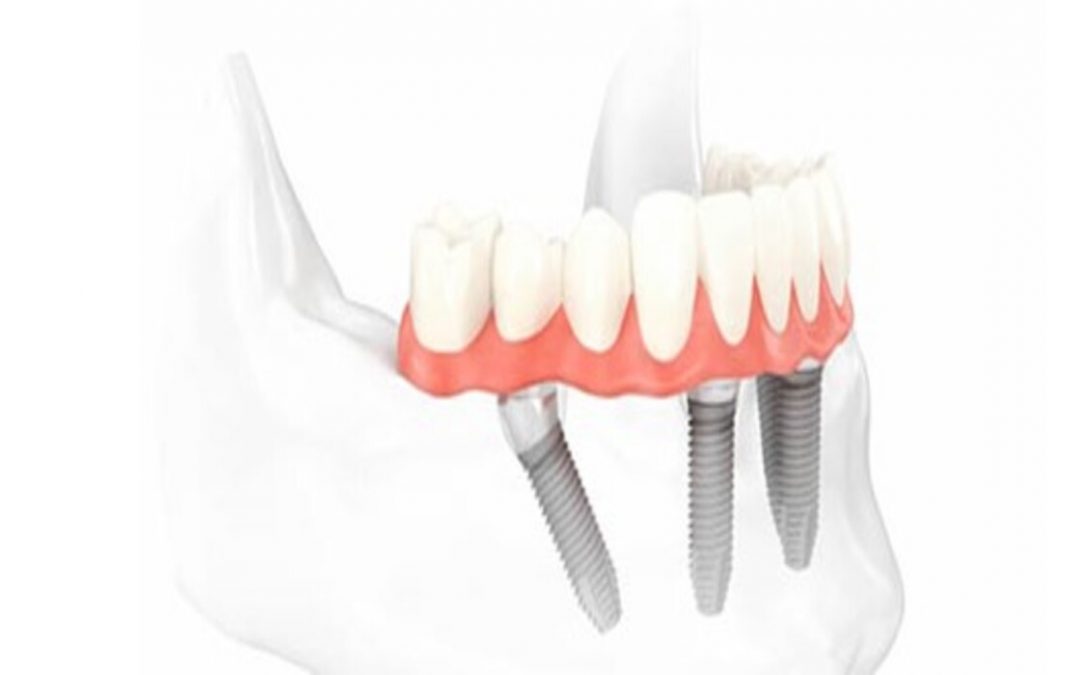 Recupera tu sonrisa en 1 día con implantes dentales de carga inmediata