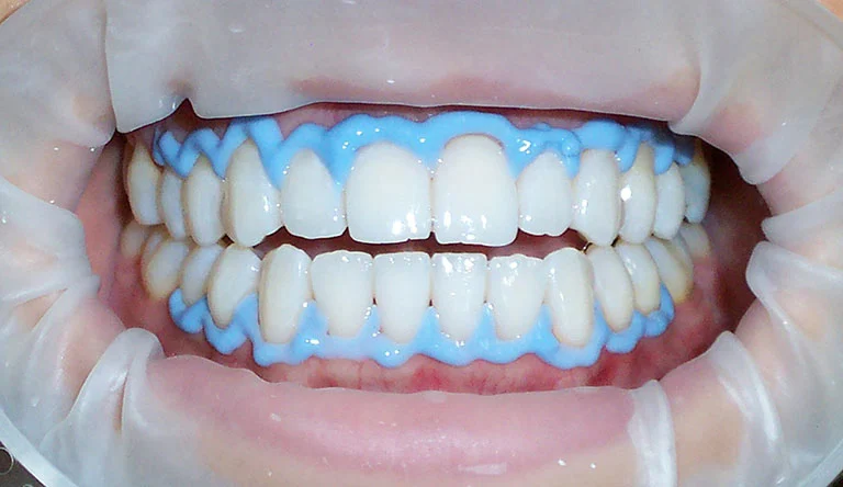blanqueamiento dental en clínica