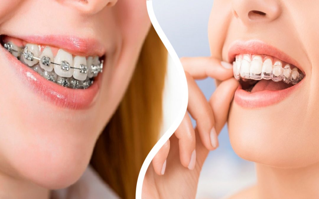 brackets vs ortodoncia invisible