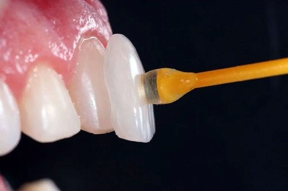 carillas dentales de composite