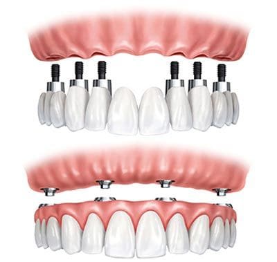 diferencias entre prótesis dentales fijas y removibles