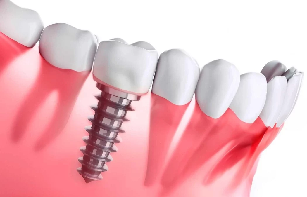 implantes dentales en madrid