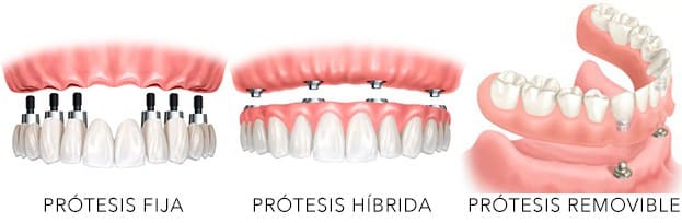 prótesis dentales fijas y removibles