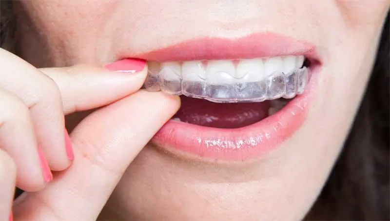 tipos de ortodoncia invisalign