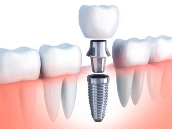 Costo de un implante de muela