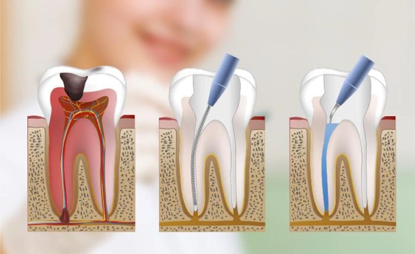 Cuánto se tarda en hacer una endodoncia: Tiempo y factores a considerar 3 Cuánto tiempo dura una endodoncia