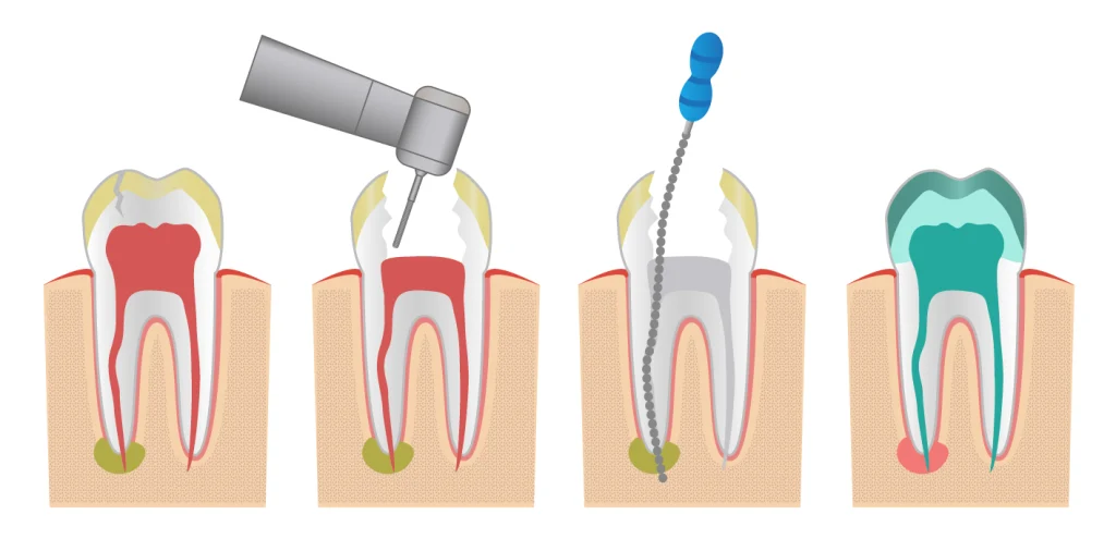 Cuánto se tarda en hacer una endodoncia: Tiempo y factores a considerar 1 Duración aproximada de una endodoncia