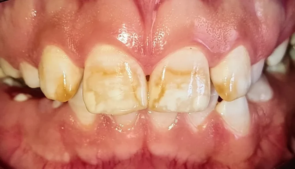 Fluorosis dental: Causas, síntomas y tratamientos 2 Causas de la fluorosis dental
