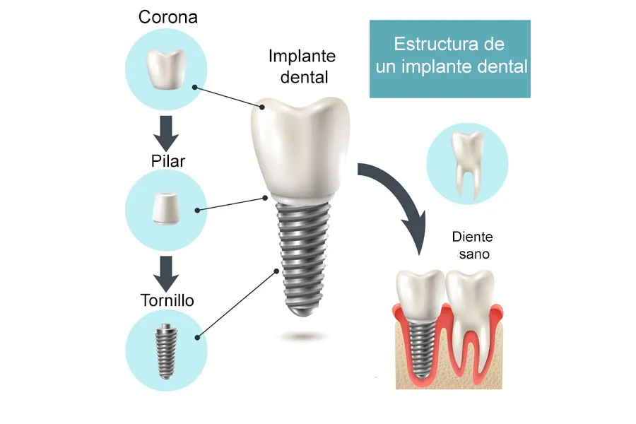Colocación de implantes con corona