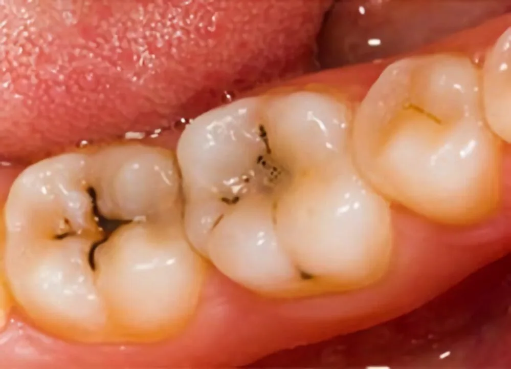 consecuencias de dejar mucho tiempo una muela con caries