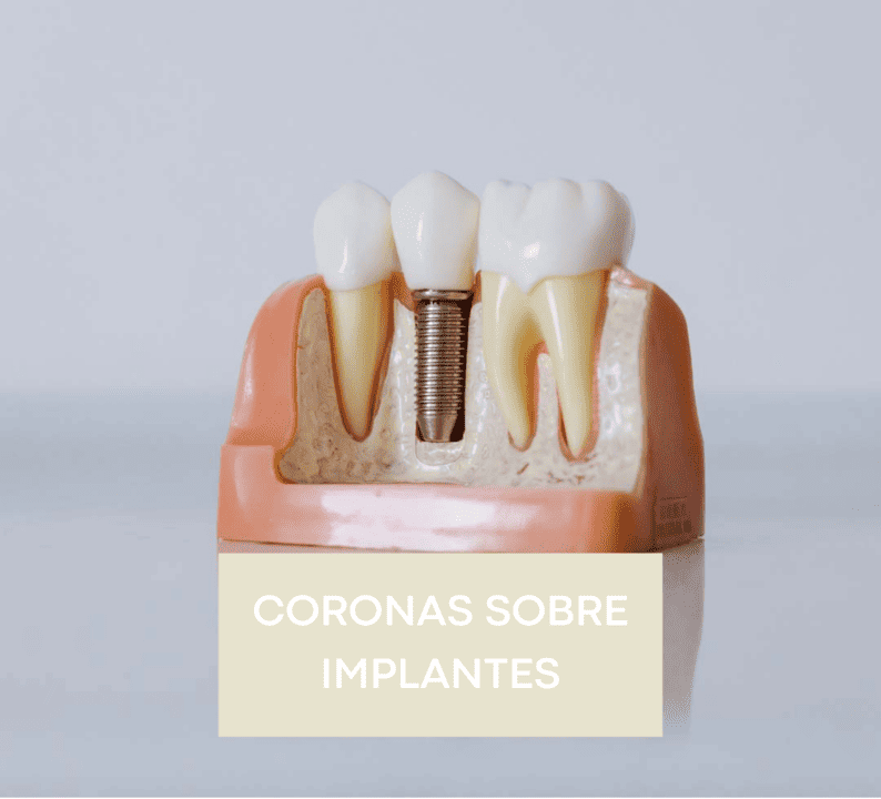 coronas-dentales-sobre-implantes