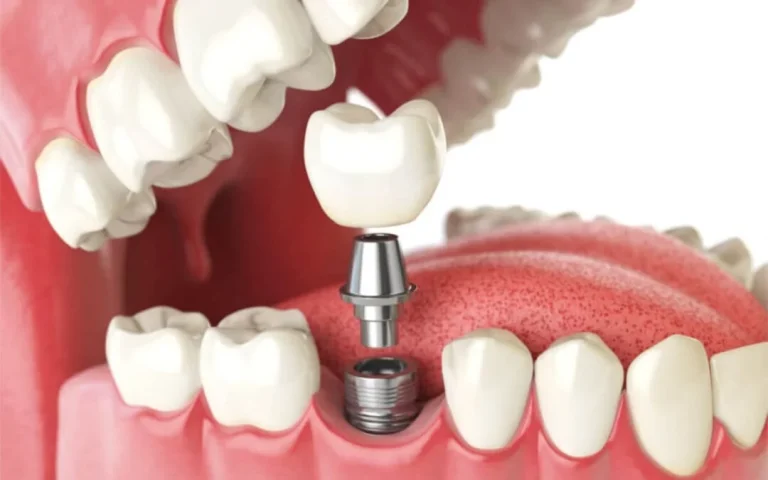 Implantes con corona