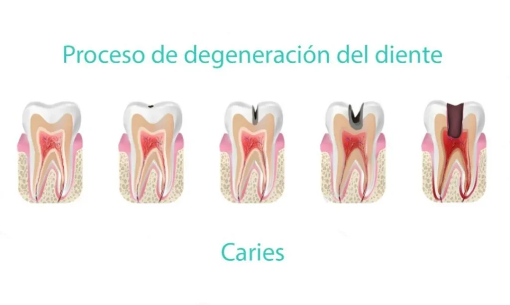 Por qué se pica una muela