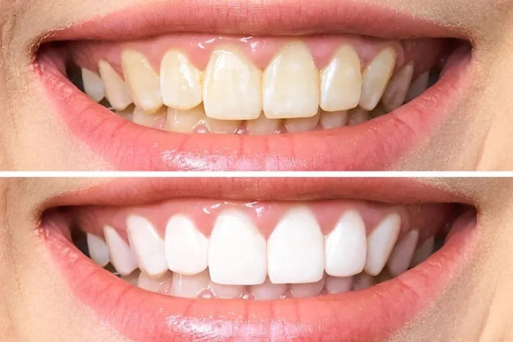 Fluorosis dental: Causas, síntomas y tratamientos 1 Qué es la fluorosis dental