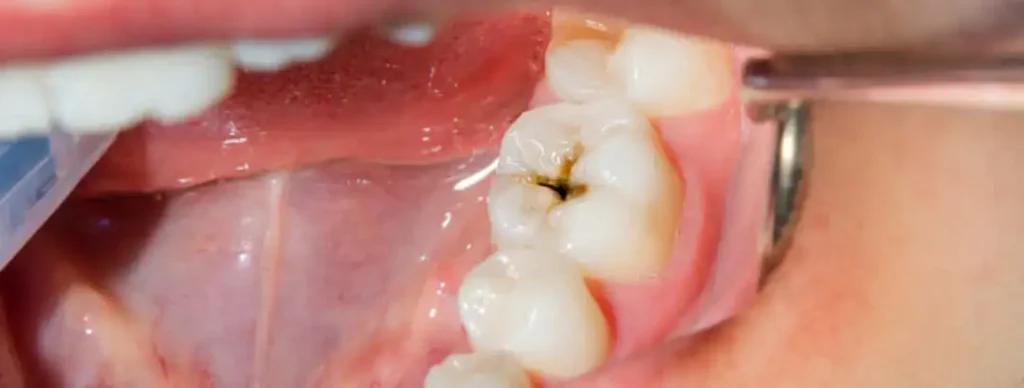 Qué pasa si tengo una muela con un agujero