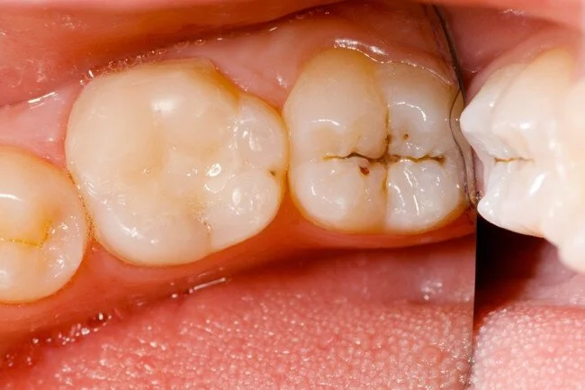 Señales de una muela con caries