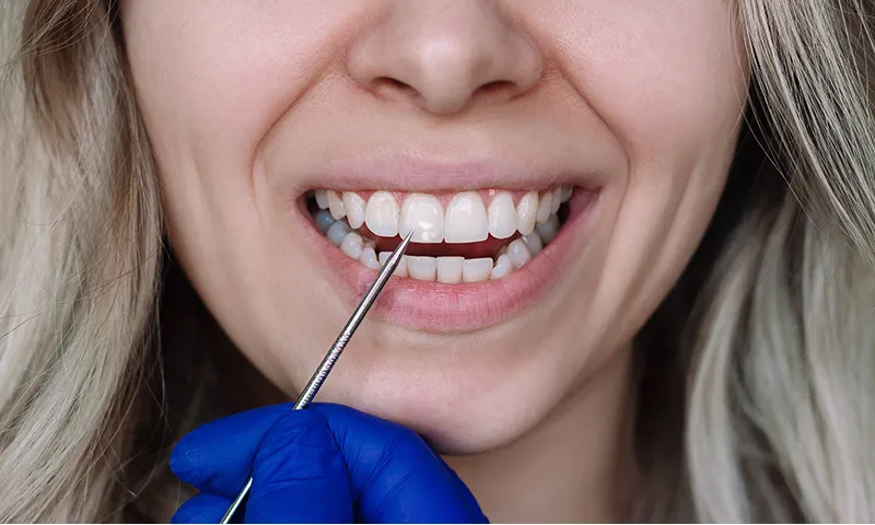 Fluorosis dental: Causas, síntomas y tratamientos 3 Tratamientos para la fluorosis dental