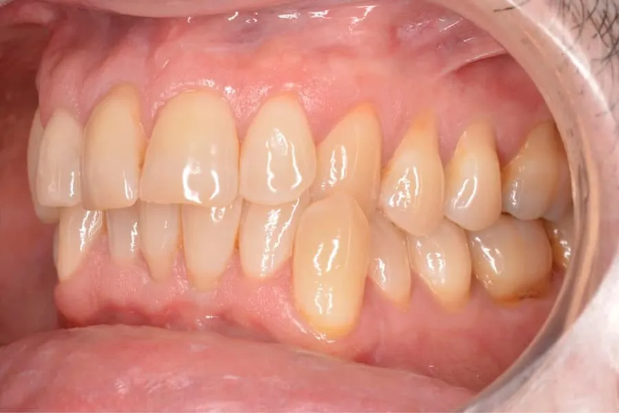 Mordida cruzada anterior: Causas, síntomas y tratamientos eficaces 2 Qué es la mordida cruzada anterior