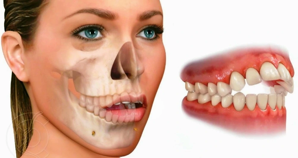 Mordida cruzada anterior: Causas, síntomas y tratamientos eficaces 1 Causas de la mordida cruzada anterior