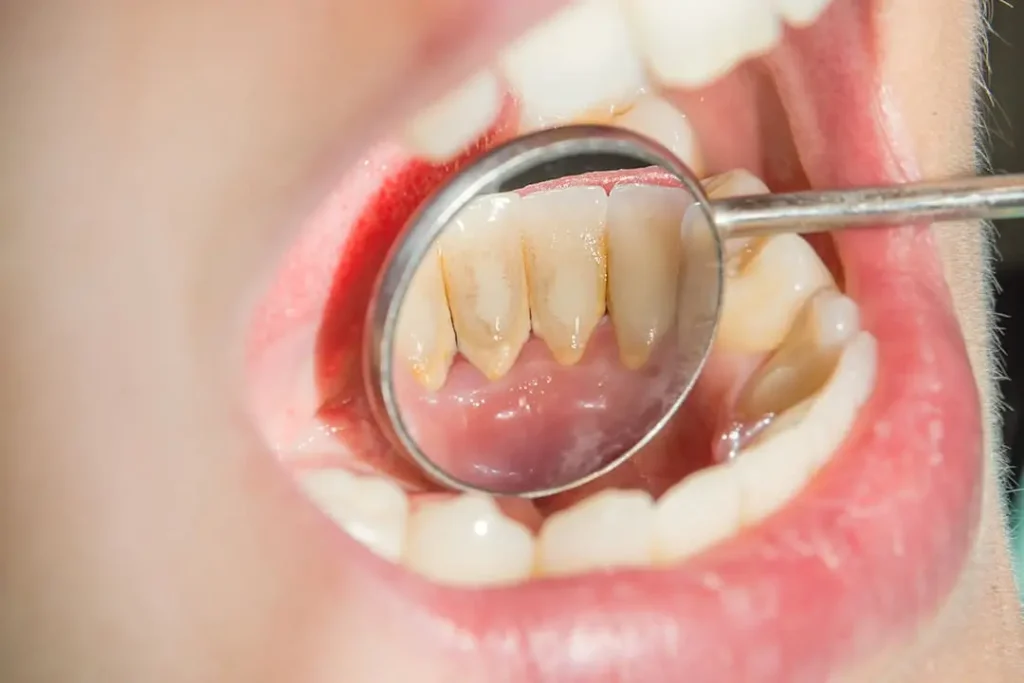 Dientes amarillos: Causas, prevención y soluciones efectivas 2 Cómo blanquear los dientes amarillos en 2 minutos