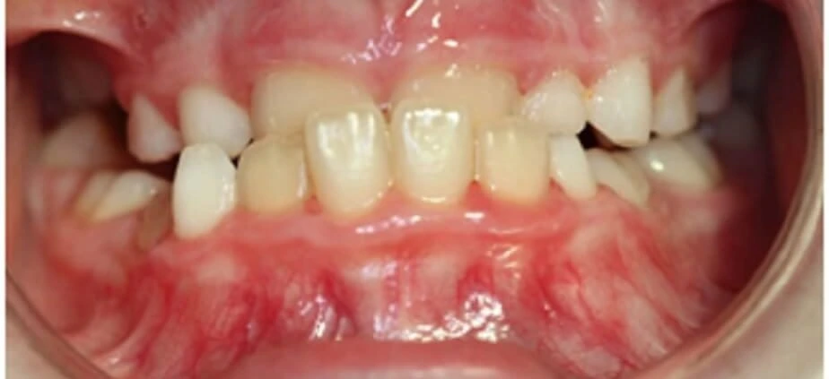 Mordida cruzada anterior: Causas, síntomas y tratamientos eficaces 3 Cómo corregir mordida cruzada anterior en niños