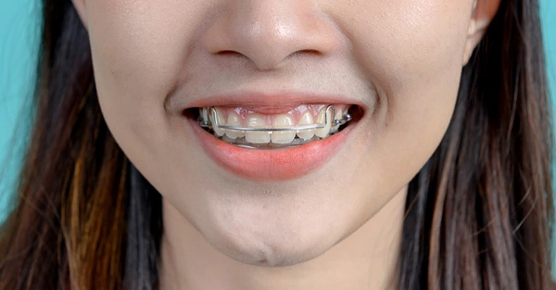 ¿Los retenedores son para siempre?: Consecuencias de dejar de usarlos 3 Cuánto tiempo deben usarse los retenedores dentales