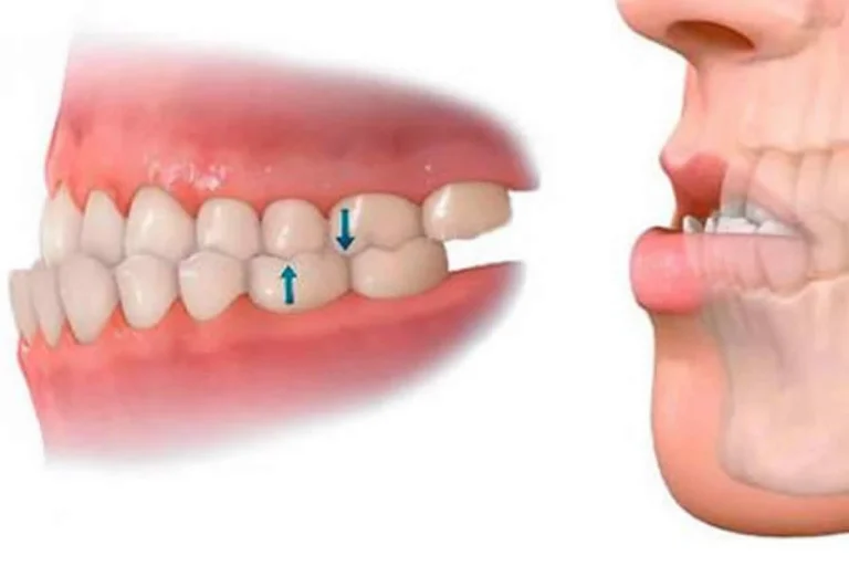 Mordida cruzada anterior