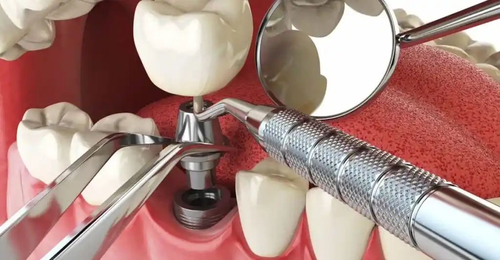 Cuánto cuesta un implante dental Madrid: Precio y factores a considerar 2 Precios de implantes dentales en Madrid