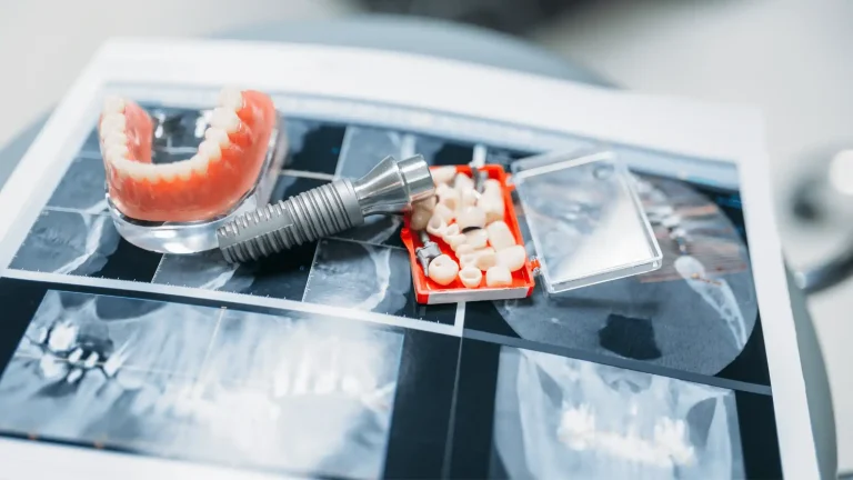 Cuánto cuesta una prótesis dental