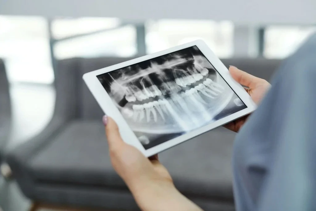 Cuánto cuesta un implante dental Madrid: Precio y factores a considerar 4 Cuánto vale un implante dental en Madrid