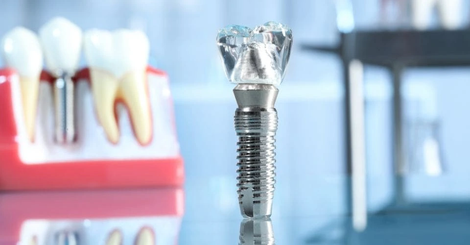 Cuánto cuesta un implante dental Madrid: Precio y factores a considerar 3 Tratamiento completo con implantes dentales