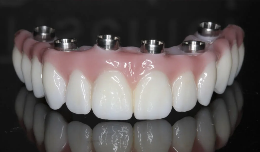 Cuánto cuesta una prótesis dental: Precios y factores a considerar 2 Qué factores influyen en el precio de una prótesis dental