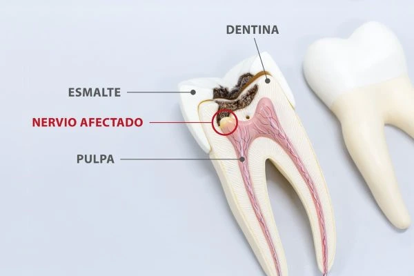 ¿Qué es una endodoncia y por qué es importante para tu salud dental? 1 Cómo es una endodoncia