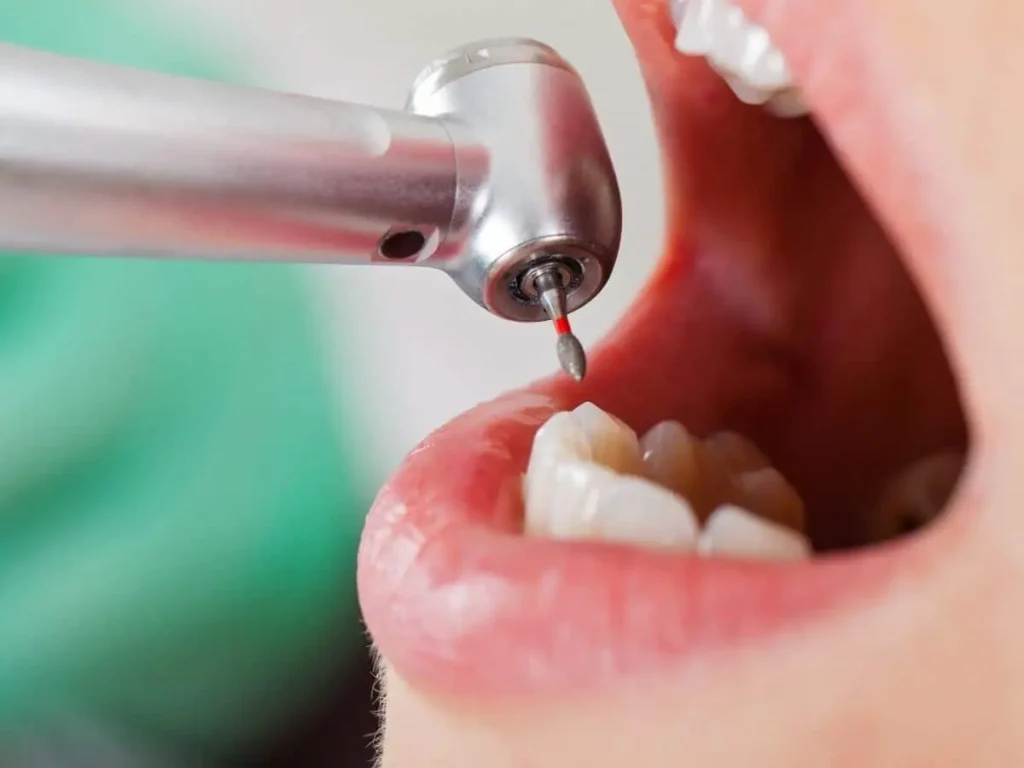 ¿Con endodoncia se puede hacer ejercicio? Lo que necesitas saber 2 Efectos del ejercicio después de la endodoncia