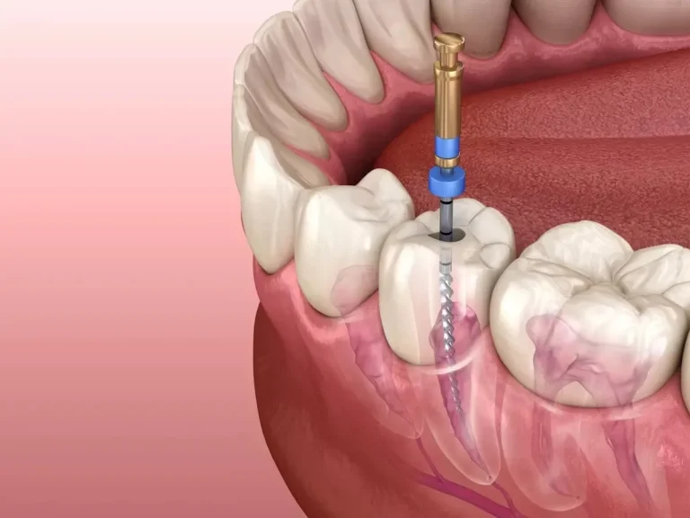 Qué es una endodoncia