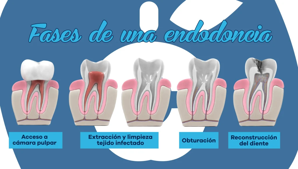 ¿Qué es una endodoncia y por qué es importante para tu salud dental? 3 Qué significa endodoncia