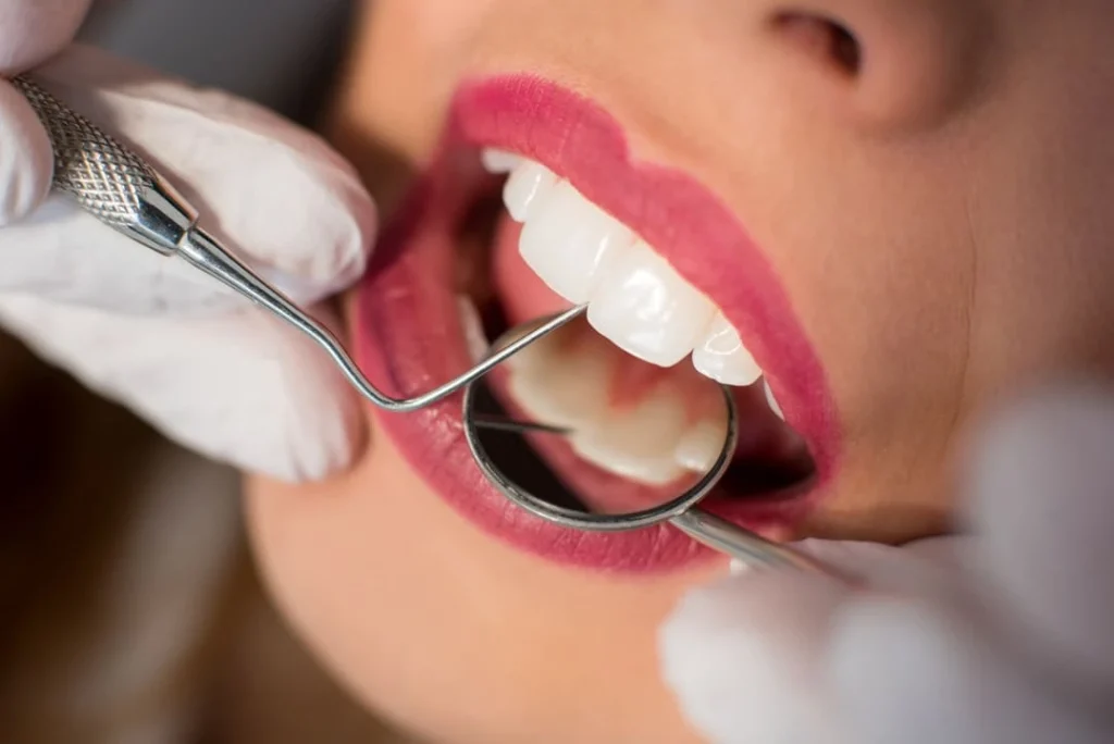 ¿Qué es una endodoncia y por qué es importante para tu salud dental? 4 Cuidados después de la endodoncia