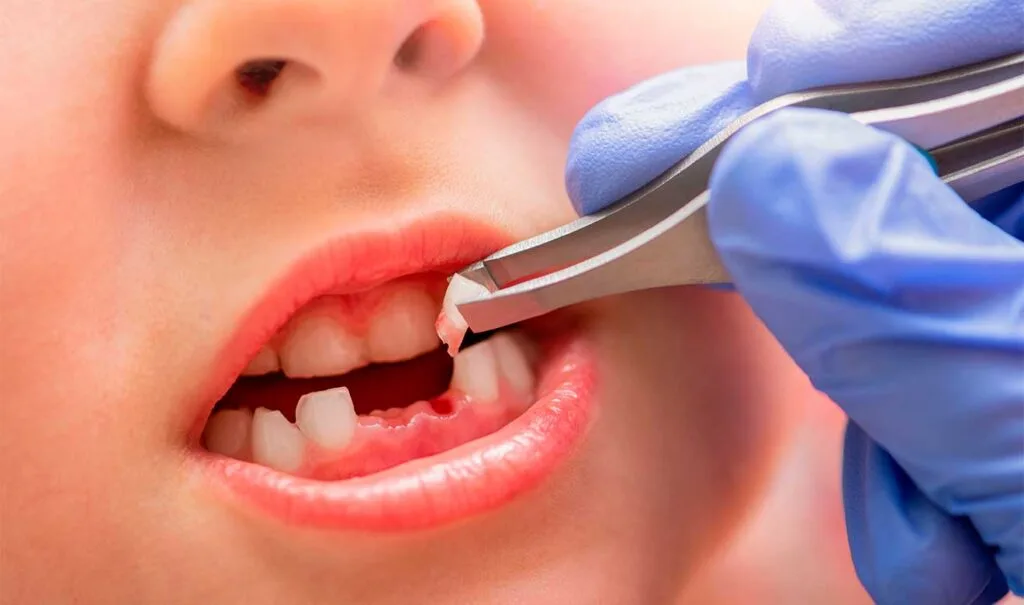 Cómo quitar un diente de leche sin dolor: Guía y consejos prácticos 3 Qué no hacer al remover un diente de leche