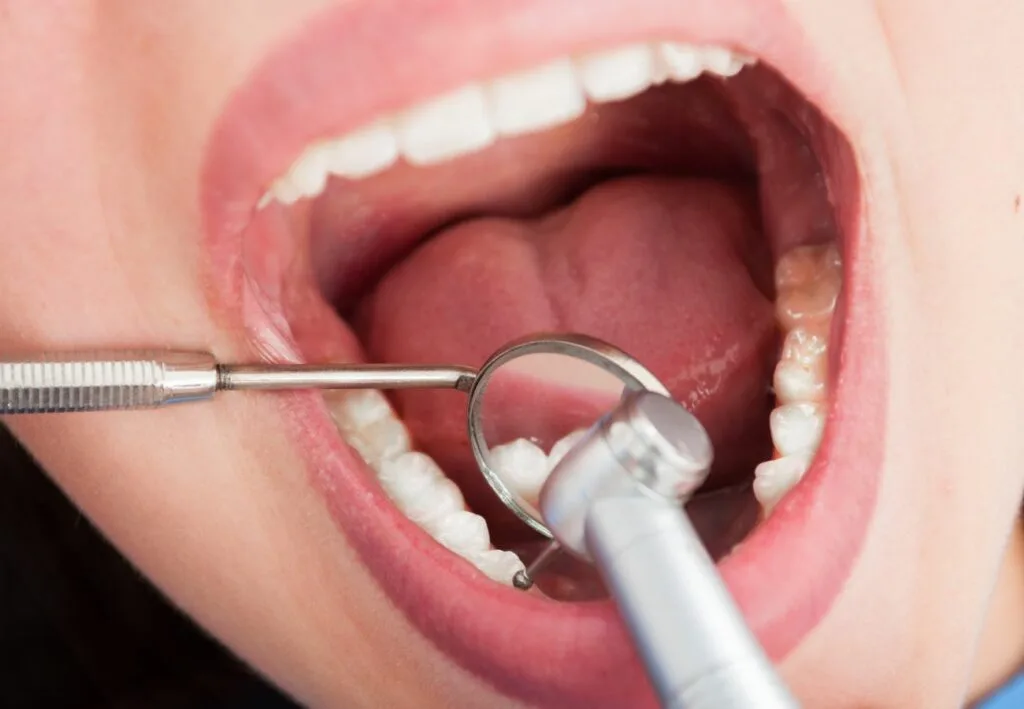 ¿Con endodoncia se puede hacer ejercicio? Lo que necesitas saber 3 Se puede hacer ejercicio después de la endodoncia