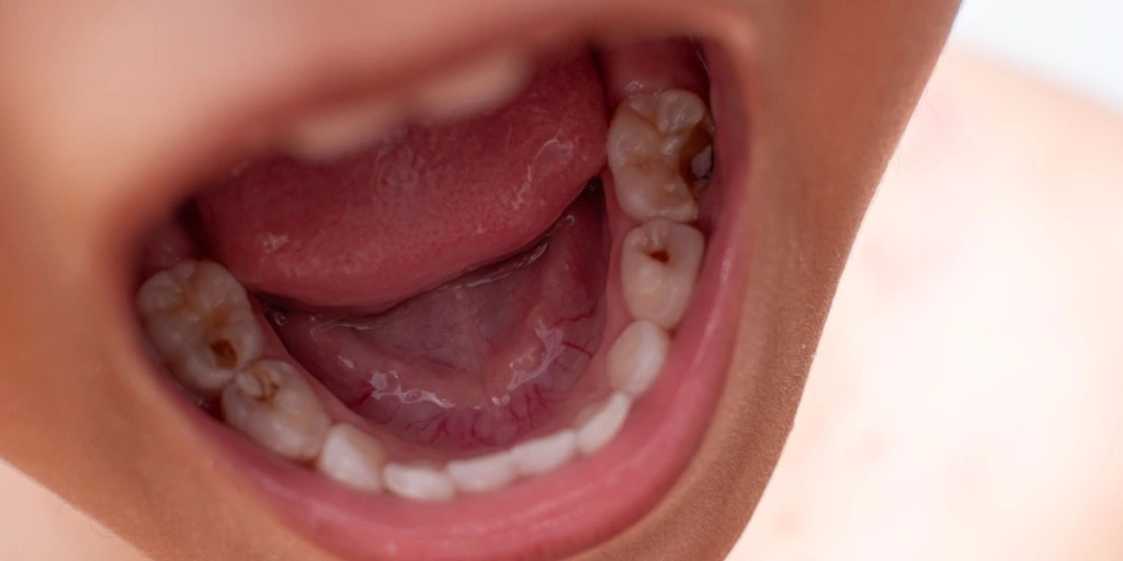 Caries en niños: Causas, síntomas y prevención 1 Por qué salen caries en los niños