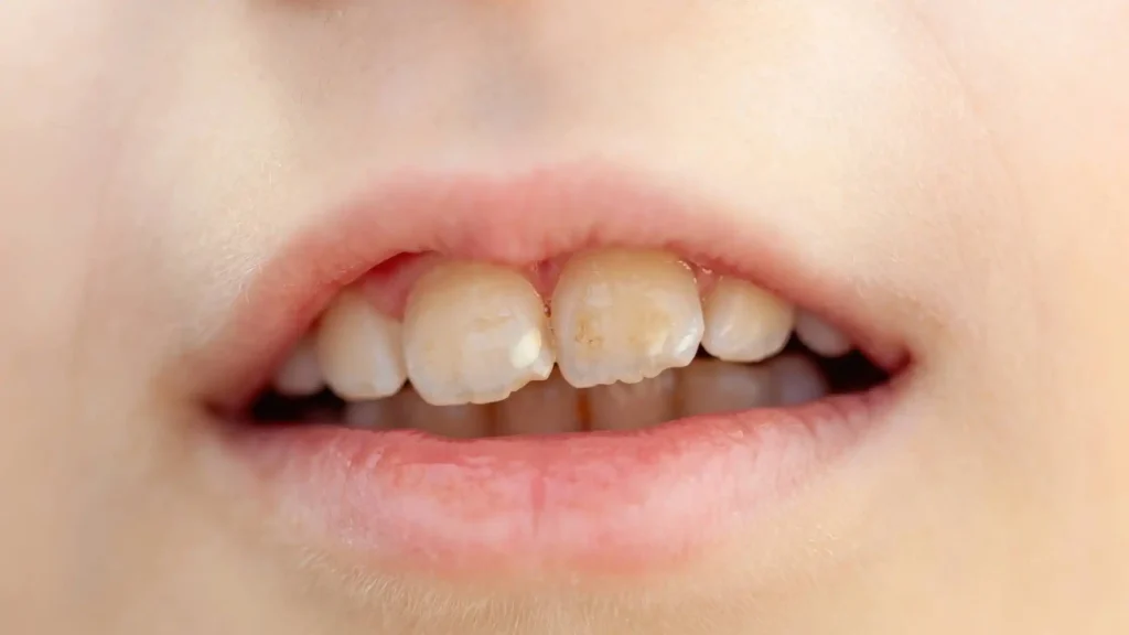 Fluorosis dental en niños: causas, síntomas y prevención 2 Síntomas de la fluorosis dental en niños