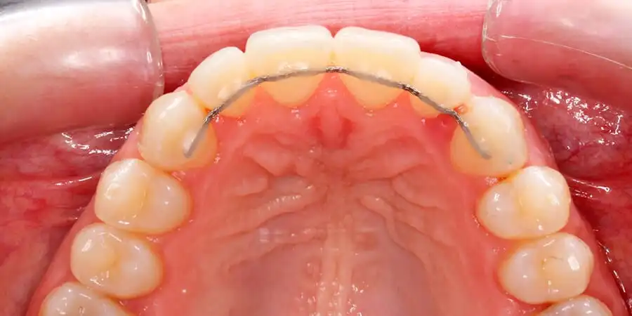 Tipos de retenedores dentales