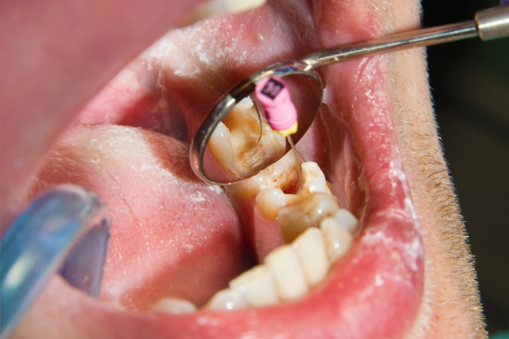 Duele más sacar una muela con endodoncia