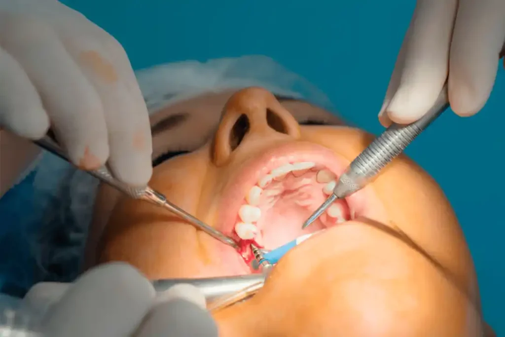 Cómo se realiza una endodoncia paso a paso