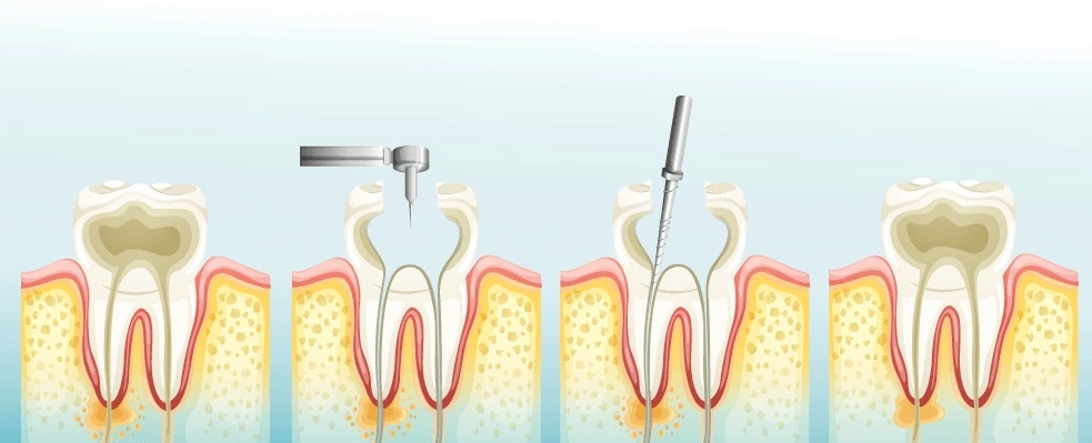 Con qué material se rellena una endodoncia