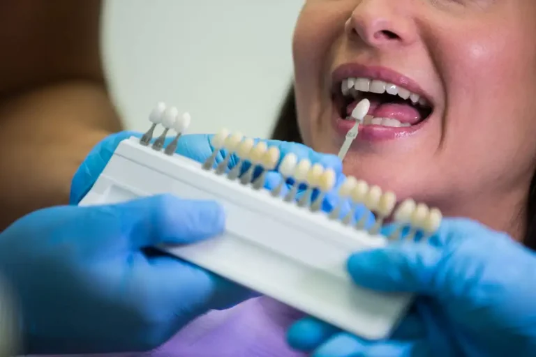 Cuánto dura una carilla dental
